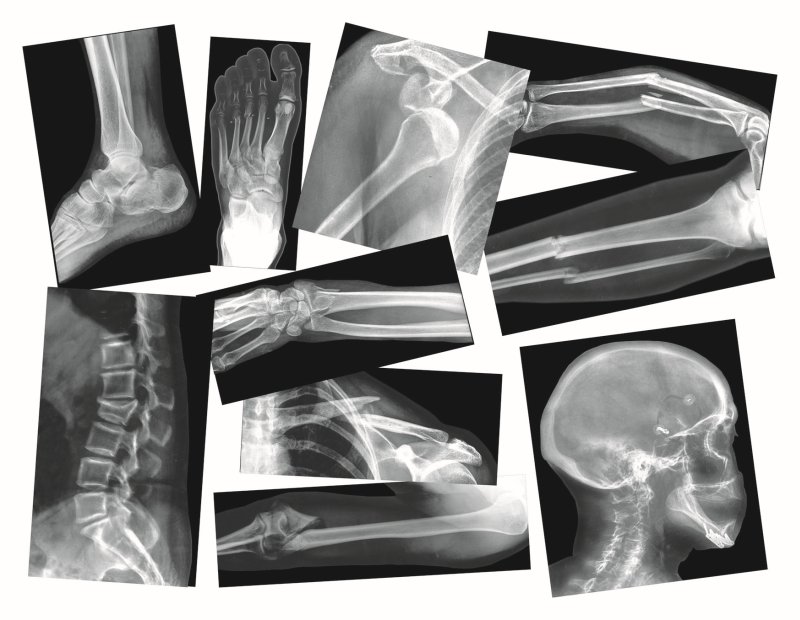 Lūžusių kaulų rentgeno nuotraukos